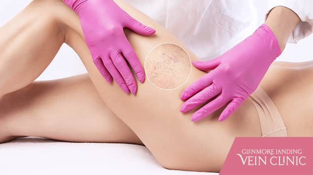 GLVC - Blog - How Does Sclerotherapy Work